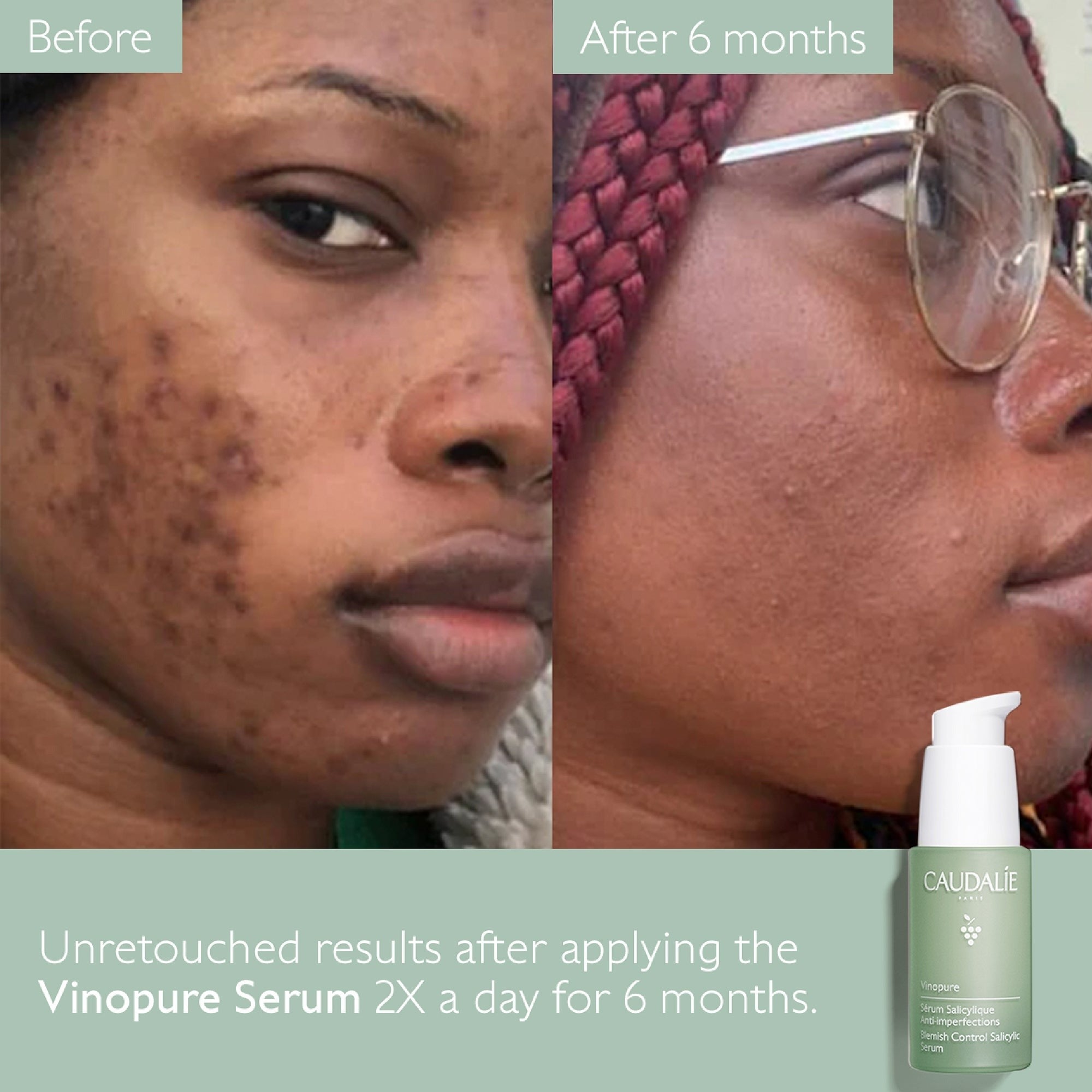 Caudalie Vinopure Blemish Control Salicylic Serum 30ml